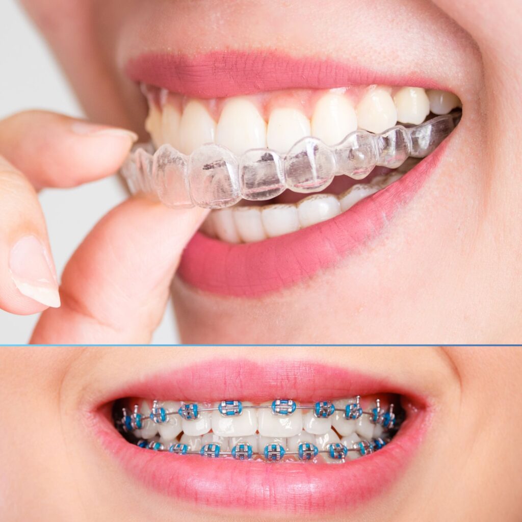 Clear Braces Are Less Painfull Than Braces