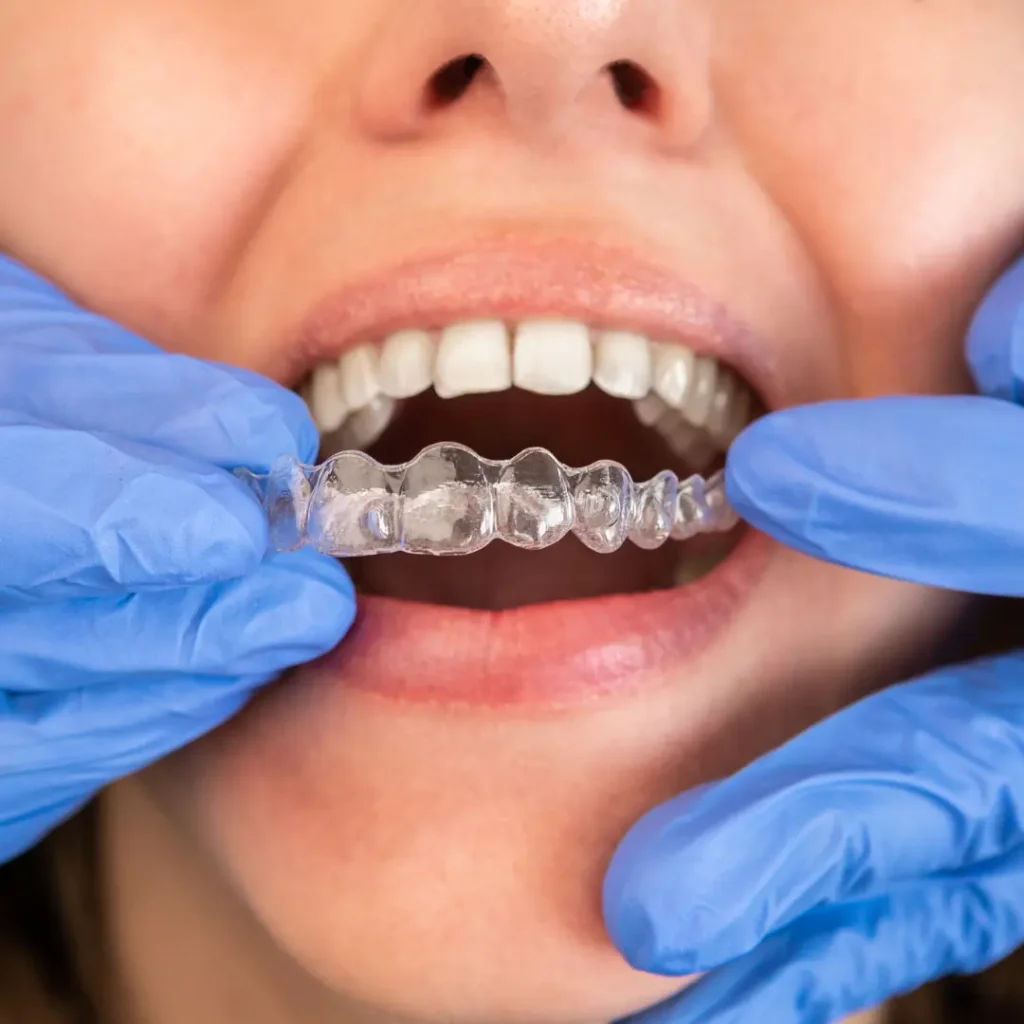 Best Clear Aligners in Boston