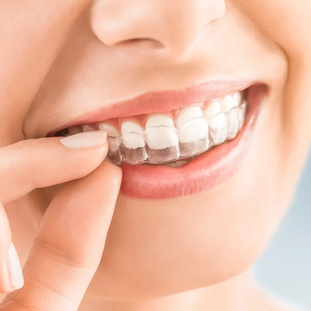 Invisalign close-up with clear aligners in Boston
